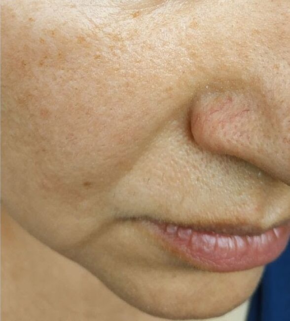 Nasolabial layers have occurred until the age of 40