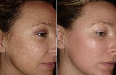 Laser rejuvenation of the skin of the face before and after photos